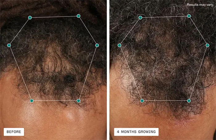 Nutrafol Men Hair Growth Pack - 90 Day Supply
